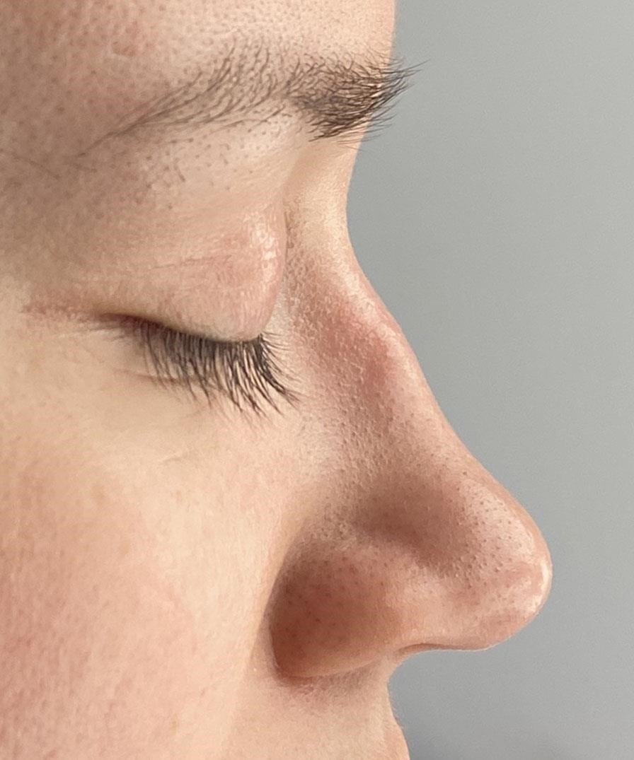 what is a closed rhinoplasty