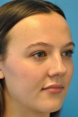 what is a closed rhinoplasty