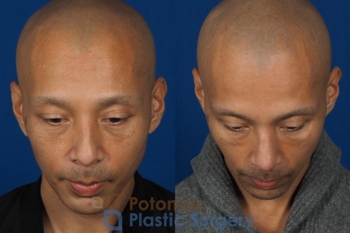 wpid-rhinoplasty-cosmetic-255-top-thumbnail.jpg